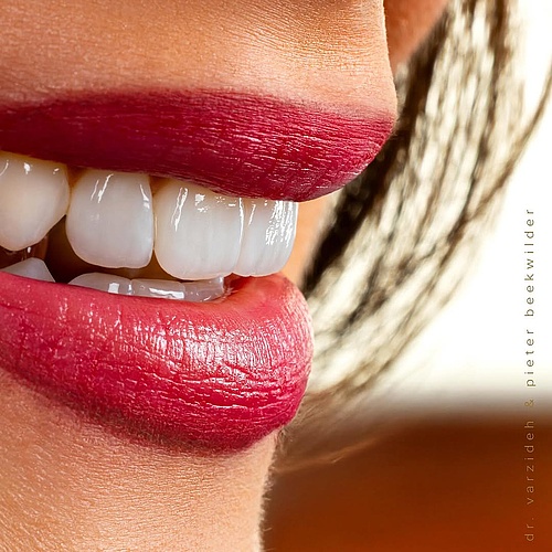 Do you see the veneers? 😌