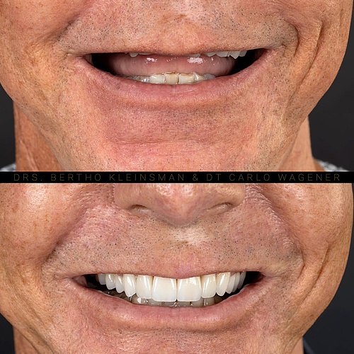Years of grinding, broken fillings, discoloration, and hidden decay had completely changed this smile and bite...