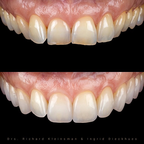 2 non-prep veneers to enhance shape and color for this 45-year-old patient. The fuller smile was designed to support... 2 non-prep veneers to enhance shape and color for this 45-year-old patient. The fuller smile was designed to support...