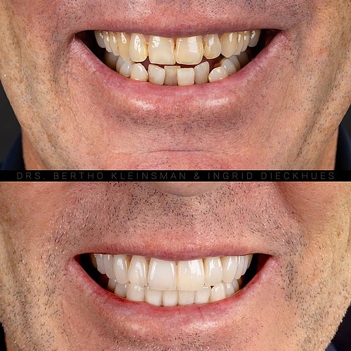 20 veneers in total. . . Dentist: @berthokleinsman Dental Technician: @ingriddieckhues . . 📸:...