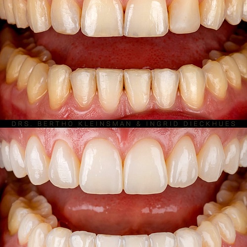 A subtle change with a big impact. This smile makeover was done with veneers from upper jaw 16–26 and lower jaw 35–45 —...