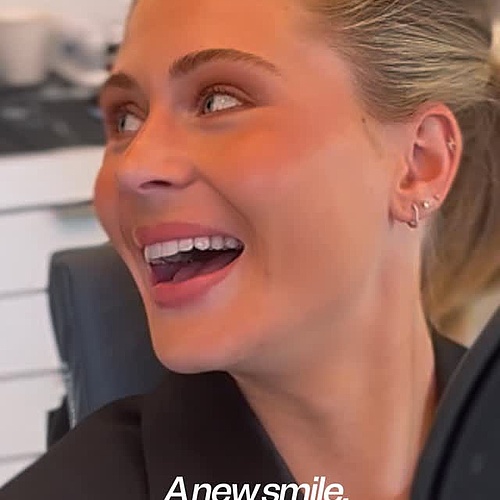 POV: Minimal prep. Maximum precision.✨ Non-prep veneers may look effortless in the final reveal. In reality, every...