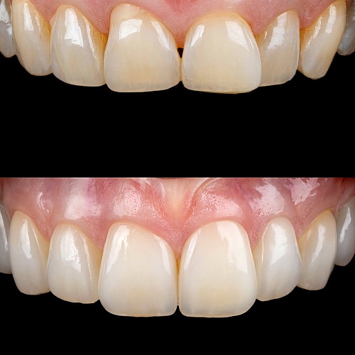 Here we go again.
8 non prep veneers to change the whole look.
The total treatment will create a natural and fresh... Here we go again.
8 non prep veneers to change the whole look.
The total treatment will create a natural and fresh...