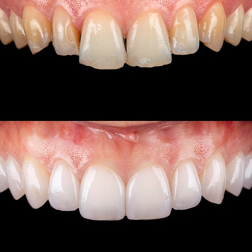 A treatment focused on color, form and position, resulting in a natural and balanced smile Completed in just two...