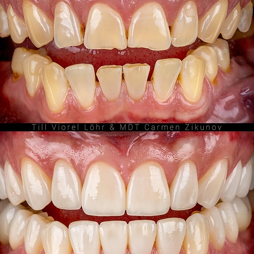 Dental abrasion – gently rehabilitated The posterior regions were restored with implants, major defects with crowns,...