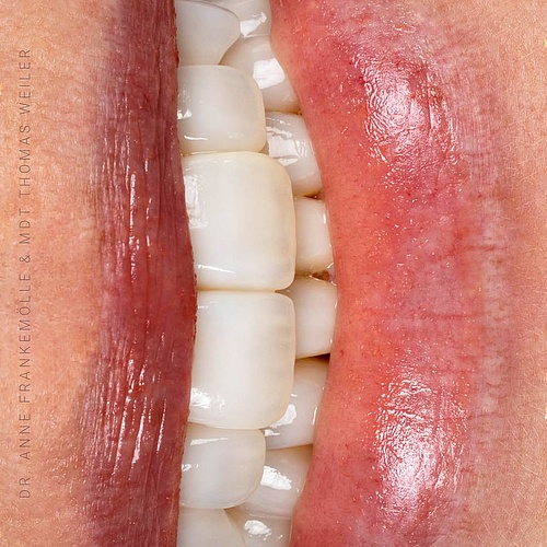 A smile is more than beauty—it is identity. For years, this patient held hers back. Not by choice, but because it no...