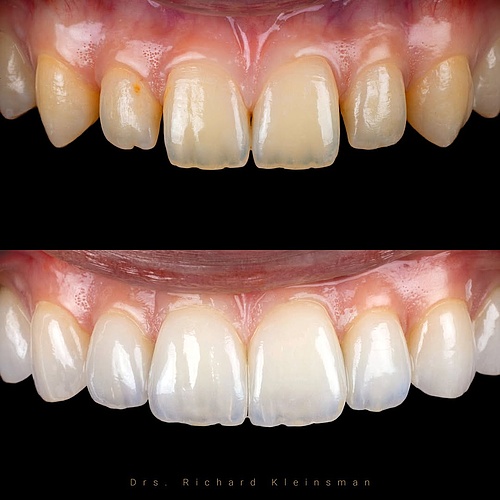 Full restoration with non-prep veneers A full makeover using non-prep veneers ; with no damage to her natural teeth....