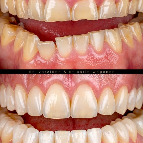 This patient wanted to get a nice smile after years of bruxism. Complete makeover with veneers in the upper and lower...