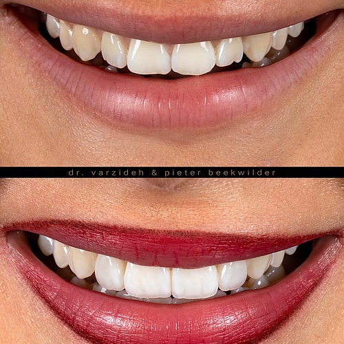 No drilling No damage No pain No provisional No risk Just precisely planned und well executed (@dr.varzideh) Dentist:...