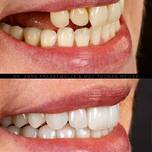 A smile is more than beauty—it is identity. For years, this patient held hers back. Not by choice, but because it no... A smile is more than beauty—it is identity. For years, this patient held hers back. Not by choice, but because it no...