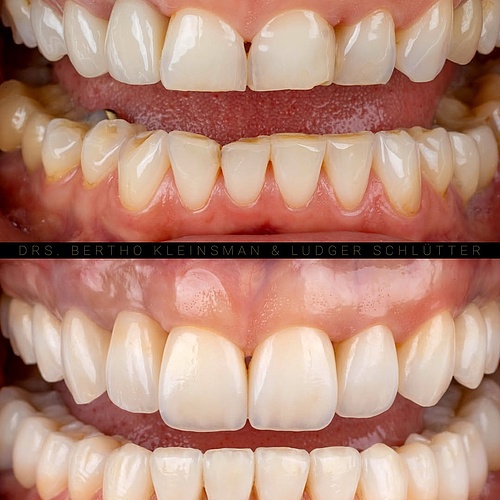 A full smile rehabilitation with function and aesthetics in balance. The bite was rebuilt and raised after years of wear...