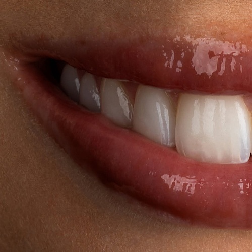 We removed old composite veneers and replaced them with handcrafted porcelain veneers for a more natural, refined... We removed old composite veneers and replaced them with handcrafted porcelain veneers for a more natural, refined...