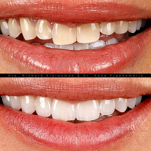 A smile should feel natural, balanced and timeless. . . Dentist: @drs.richardkleinsman Co-Dentist: @annefrankemolle...