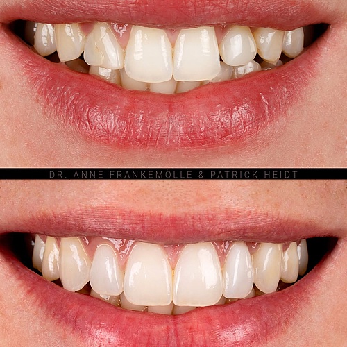 Six minimally invasive veneers. . . Dentist: @annefrankemolle Dental Technician: @patrick.heidt . . 📸:...