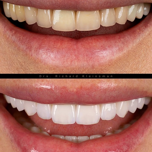 A full upper and lower jaw restoration, completed in just three appointments! This case involved 28 new crowns in...