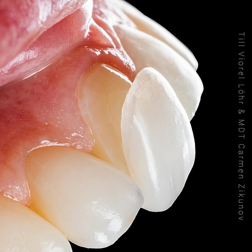 Try Fitting Ultra-thin veneers – as delicate as a contact lens! Minimally invasive but maximum outcome! The best part:... Try Fitting Ultra-thin veneers – as delicate as a contact lens! Minimally invasive but maximum outcome! The best part:...