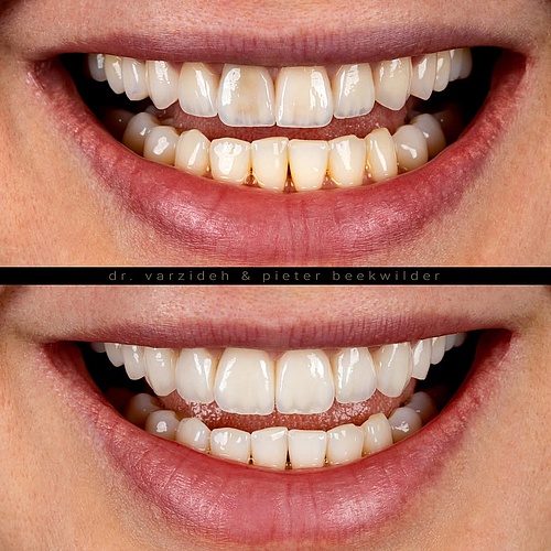 Transforming the smile with natural-looking ceramic veneers. Designed for harmony, brightness, and a confident smile. .... Transforming the smile with natural-looking ceramic veneers. Designed for harmony, brightness, and a confident smile. ....