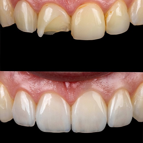 Non-prep veneers are often perceived as straightforward. Minimal intervention, minimal risk. Yet in reality, they...