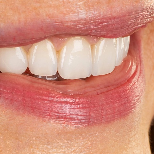 BITE LIFT | GINGIVAL HARMONIZATION | CERAMIC VENEERS & CROWNS Balanced. Natural. (@annefrankemolle) . . Dentist:...