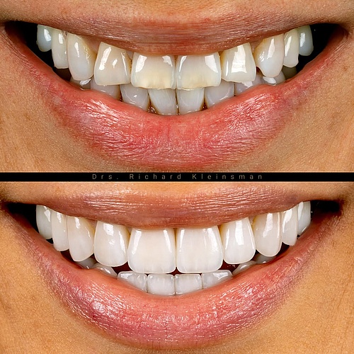 This lovely 40-year-old patient from Tokyo was unhappy with the grey color of her teeth caused by tetracycline use in...