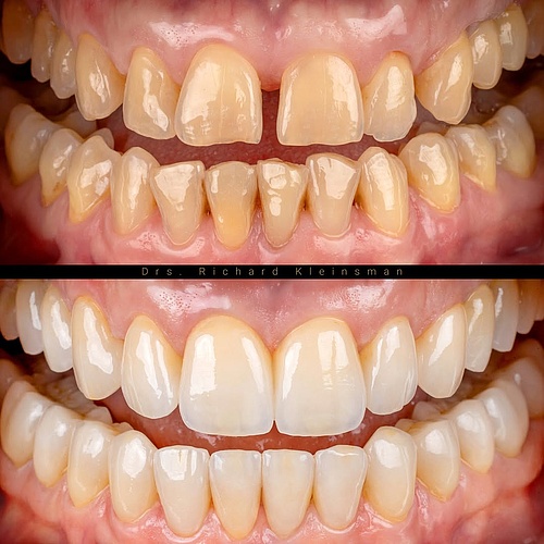 Fresh, elegant, and authentic.�A very happy patient—and a very happy dentist. . . Dentist: @drs.richardkleinsman Dental...