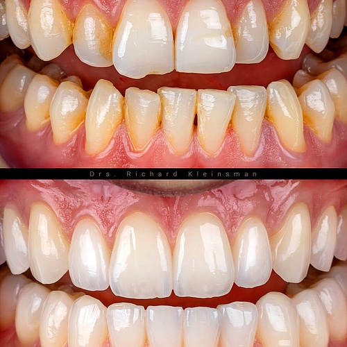 An incredible transformation ✨ 18 veneers and 8 facial layers combined with a bite lift to create space for ceramic...