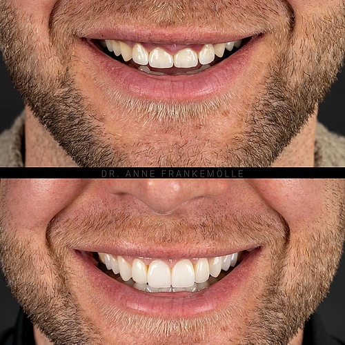 Aesthetics follow biology. This patient presented with four anterior crowns following a series of failed veneer...