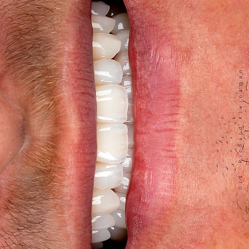 From worn to balanced — without sacrificing healthy tooth structure. This case was treated with 18 veneers and 8 facial...