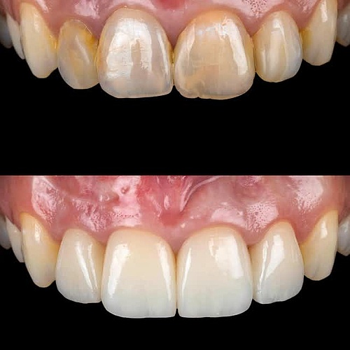 After the extraction of tooth 21, a bridge and pontic soft-tissue graft were placed — leaving no visible signs of the... After the extraction of tooth 21, a bridge and pontic soft-tissue graft were placed — leaving no visible signs of the...